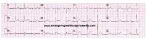 Normal ECG