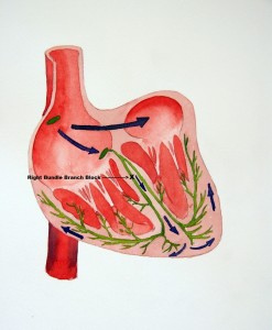 Bundle Branch Block