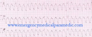 Ventricular Tachycardia